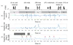 Prescreening MCI and Dementia Using Shank Mounted IMU During TUG task